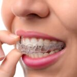 Invisalign Treatment