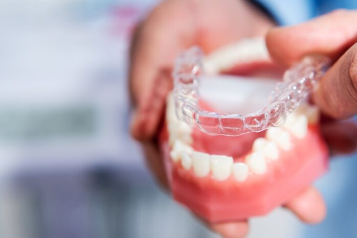 Invisalign Aligners